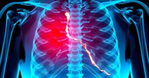 X-ray showing a broken rib with emphasis on the area of injury, with an artistic flair and vibrant color palette.